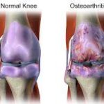 "Breaking the Joint Pain Cycle: Understanding and Managing Osteoarthritis"