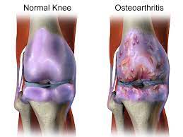"Breaking the Joint Pain Cycle: Understanding and Managing Osteoarthritis"