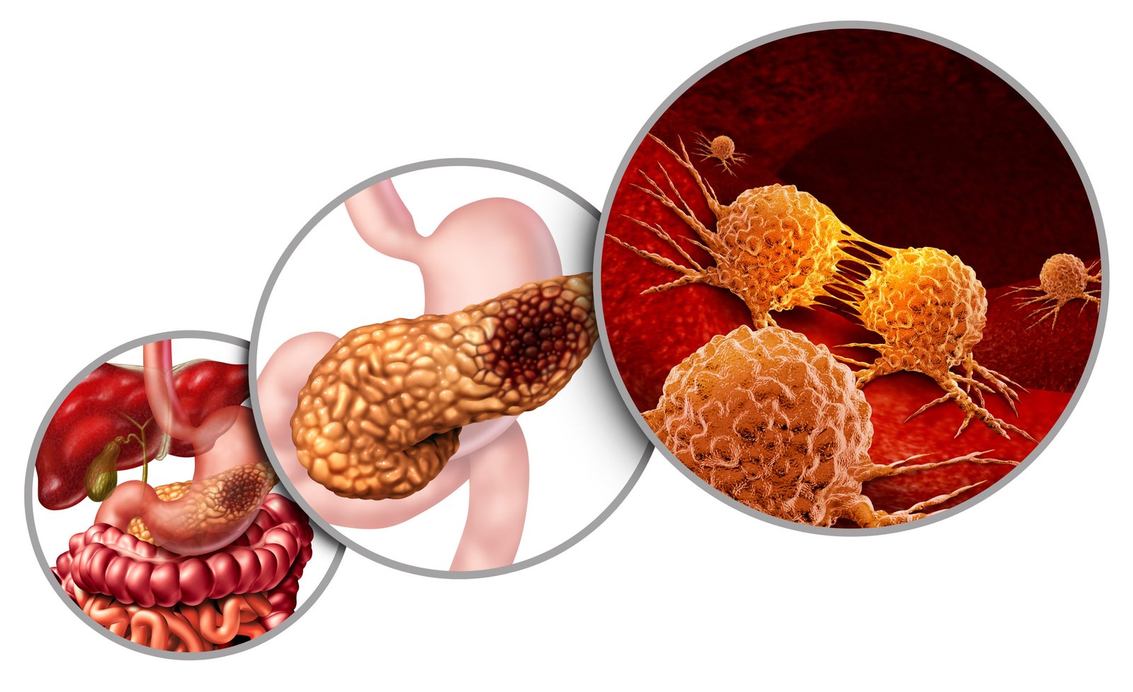 Pancreatic Cancer: The Urgent Need for Early Detection and Effective Treatments