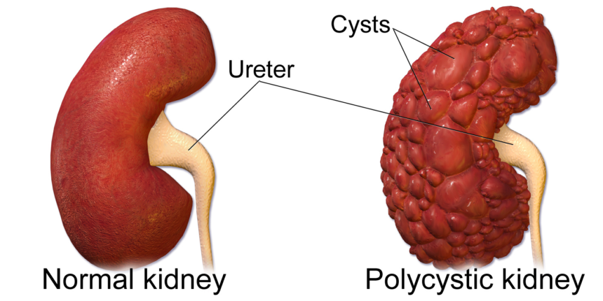 Polycystic kidney