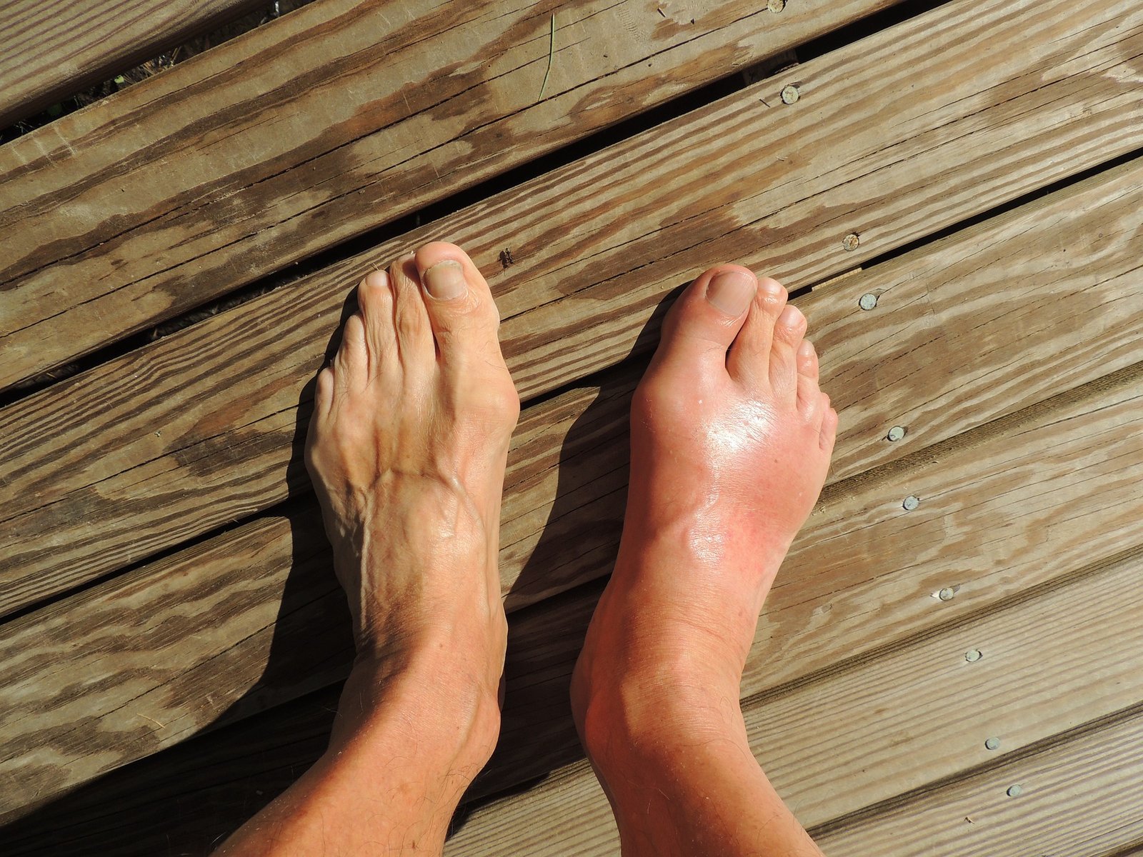 "Gout: Causes, Symptoms, and Effective Strategies for Management"