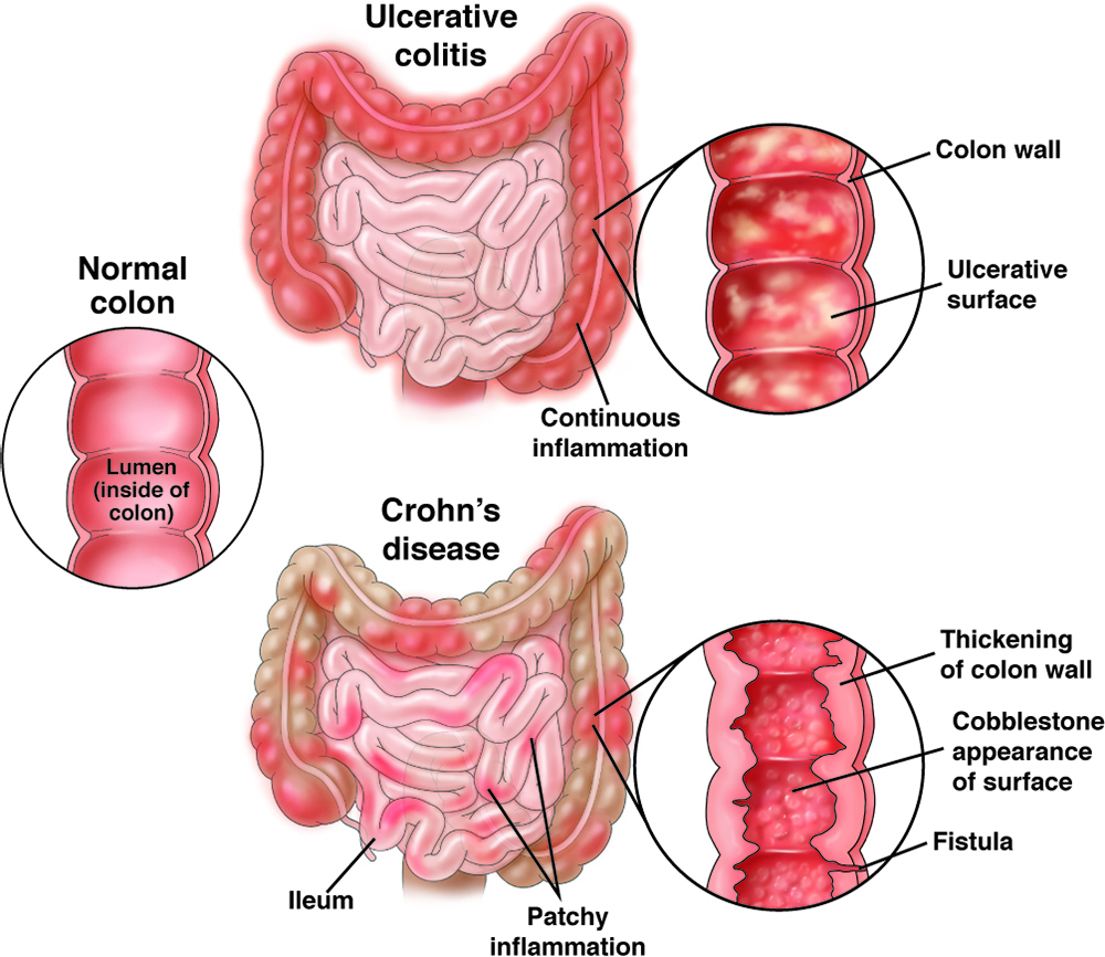 IBD: Understanding a Chronic Inflammatory Condition of the Digestive System