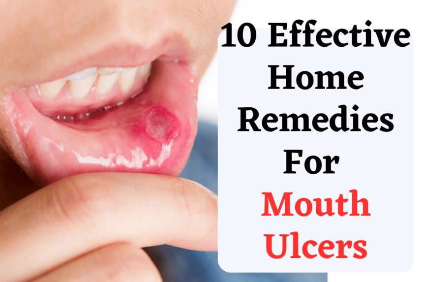 mouth ulcer remedies