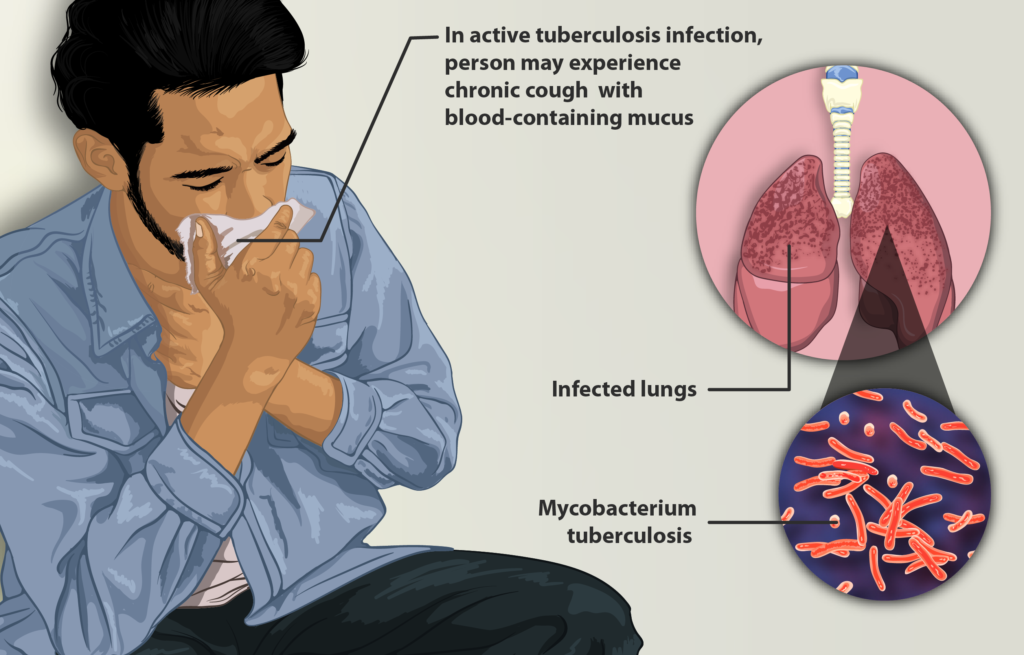 Tuberculosis (TB): Unmasking the Silent Killer