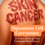 Squamous Cell Carcinoma A Closer Look at This Common Skin Cancer