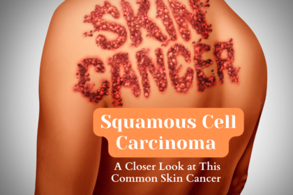 Squamous Cell Carcinoma A Closer Look at This Common Skin Cancer