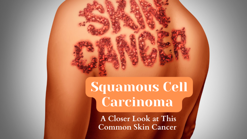 Squamous Cell Carcinoma A Closer Look at This Common Skin Cancer