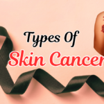 Types Of Skin Cancer (Squamous Cell Carcinoma)