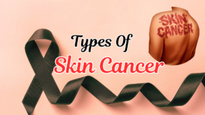 Types Of Skin Cancer (Squamous Cell Carcinoma)