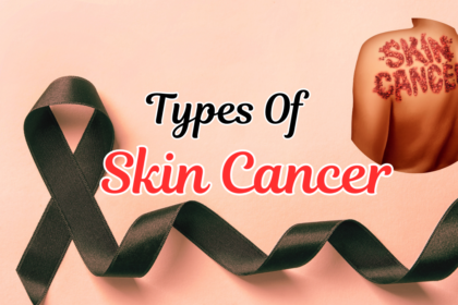 Types Of Skin Cancer (Squamous Cell Carcinoma)