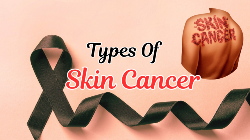 Types Of Skin Cancer (Squamous Cell Carcinoma)